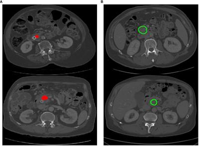 A deep learning-based cascade algorithm for pancreatic tumor segmentation